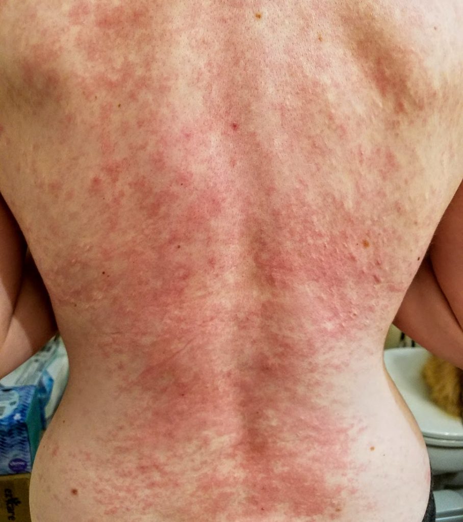 Itchy, red rash across the back from uv light and sun exposure.